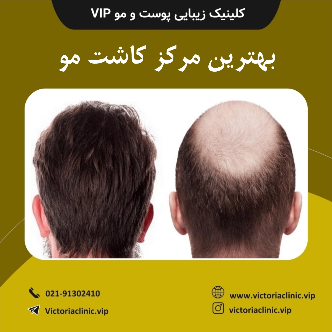 بهترین مرکز کاشت مو