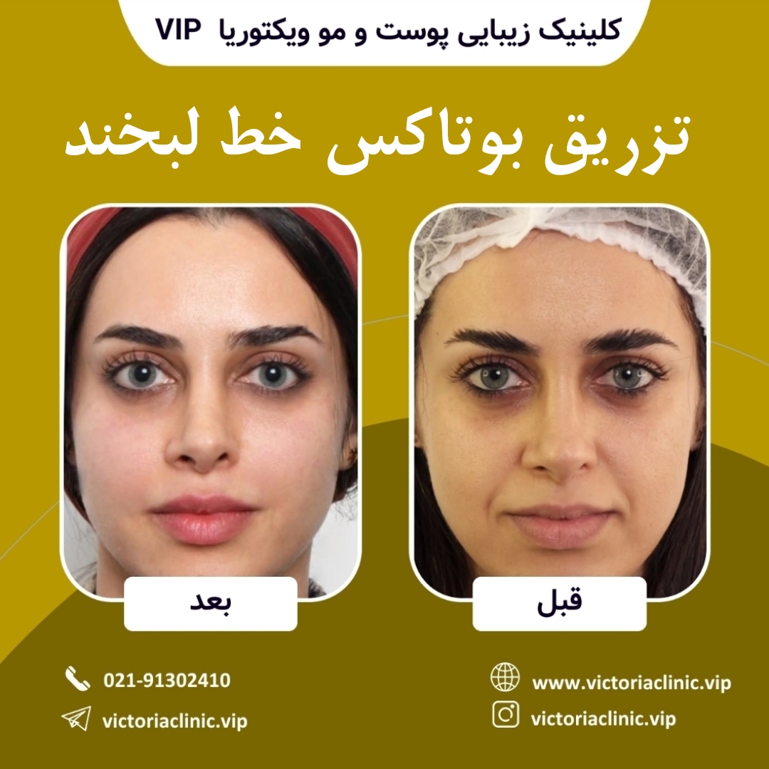 تزریق بوتاکس خط لبخند