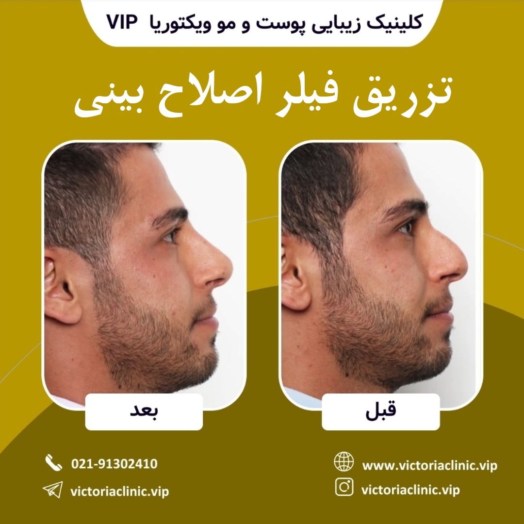 تزریق فیلر اصلاح بینی