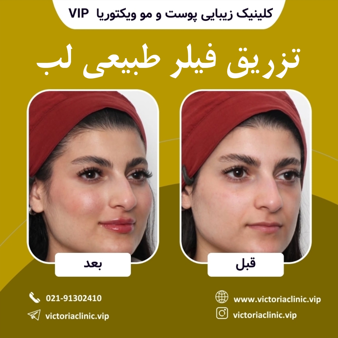 تزریق فیلر طبیعی لب