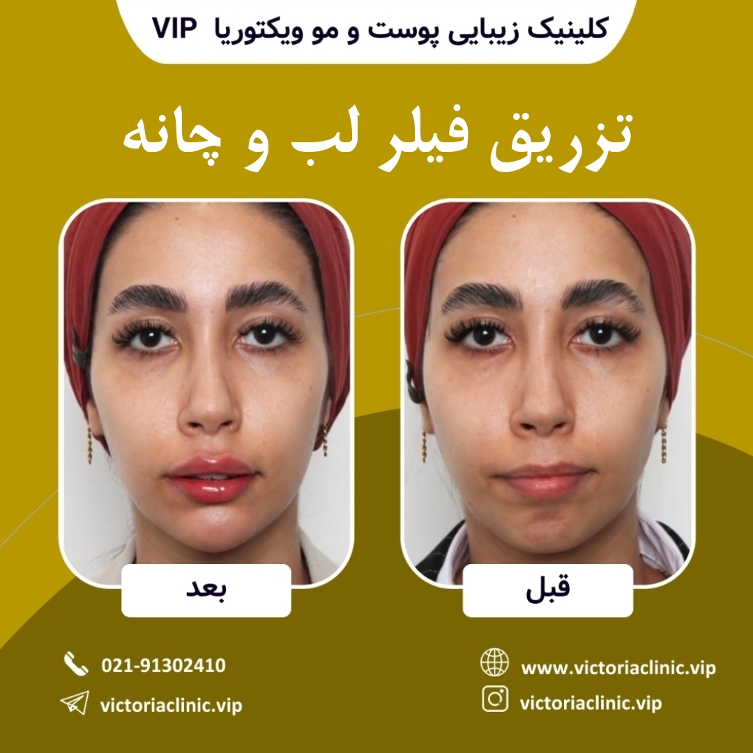 تزریق فیلر لب و چانه