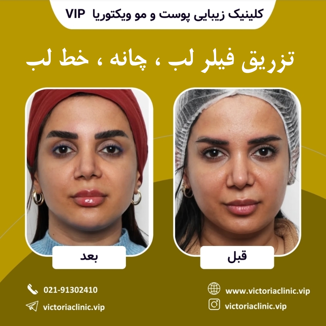 تزریق فیلر لب چانه خط لب