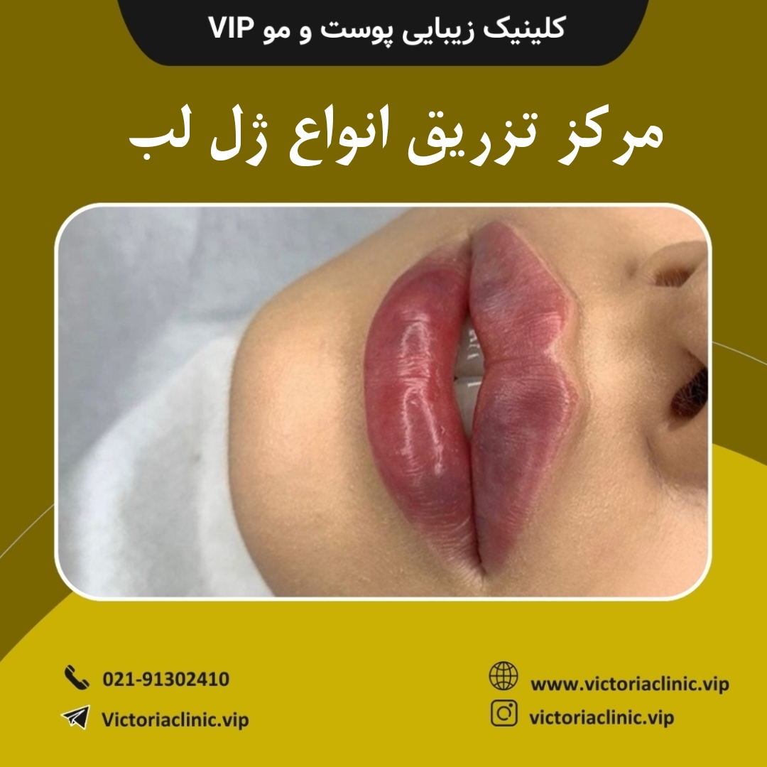 مرکز تزریق انواع ژل لب